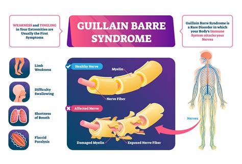 guillain barre syndrome
